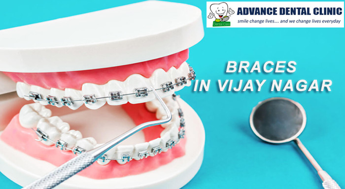 Braces in Vijay Nagar
