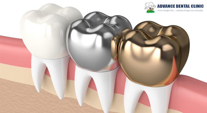 Tooth Jewellery in Mukherjee Nagar