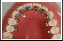 Lingual Braces
