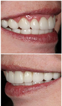 Full Mouth Rehabilitation