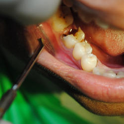 Painless Tooth Removal