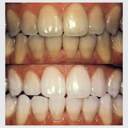 Porcelain Crowns and Veneers